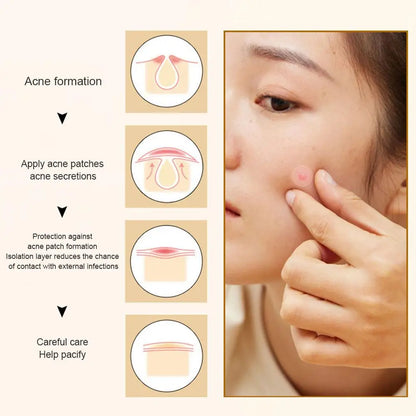 35/40pcs Acne Removal Pimple Patch Star-Shaped Invisible Hydrocolloid Pimple Patch Blemish Spot Cover Treatment Skin Care Tool