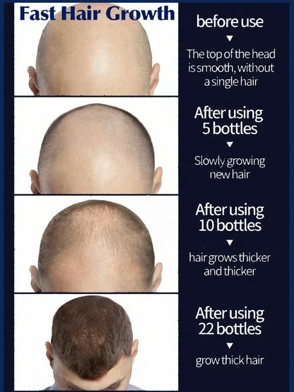 98% of buyers buy again, have more and more hair, say goodbye to baldness, thick hair,Hot selling product