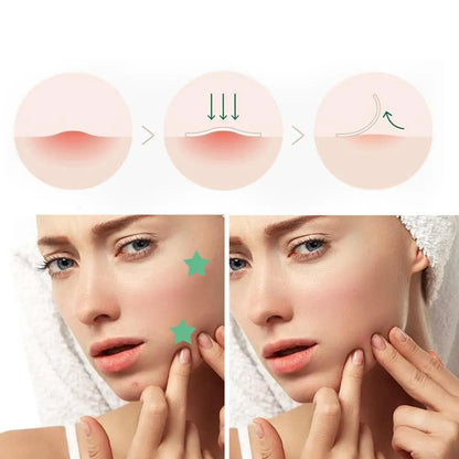 Star Pimple Patch Acne Colorful Invisible Acne Removal Skin Care Stickers Concealer Face Spot Beauty Makeup Tools 300/600pcs